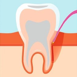 Zahnfleischentzündung mit Laser behandeln